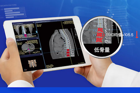 透過AI骨密度軟體可以把骨質疏鬆高風險人群篩查出來。