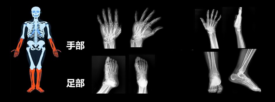 借助AI篩查，醫生可以主動告訴病人骨密度的問題，需要預防，從被動變主動。